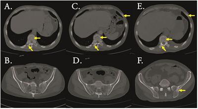 Case report: BCR-ABL-positive acute lymphoblastic leukemia with bone destruction: a treatment dilemma